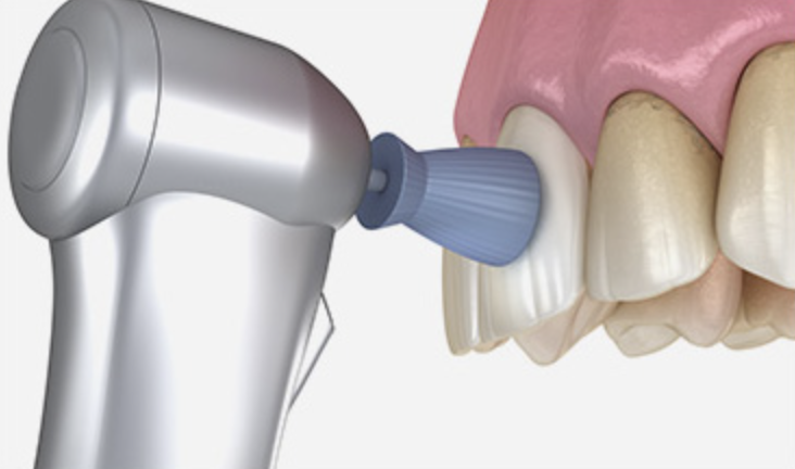 Step 02 - 치아 표면 청소