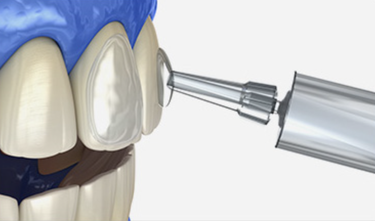 Step 04 - 잇몸 보호제 도포